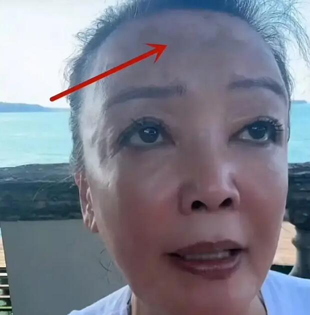 张兰说白癜风控制住了 目前正在意大利接受治疗